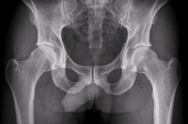Diagnostilised võimalused puusaliigese artroosi jaoks