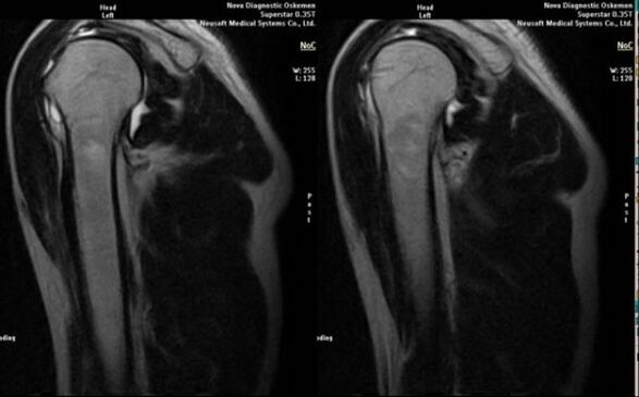 röntgen õlaliigese artroosi diagnoosimiseks