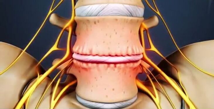 osteokondroosist tingitud selgroo kahjustused